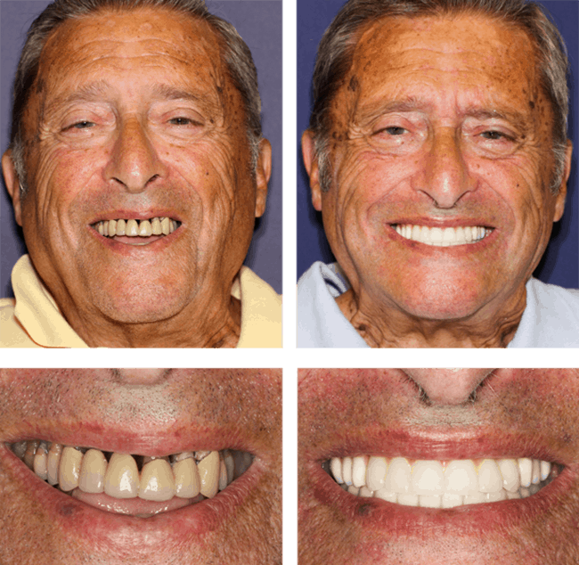 Teeth Next Day in Palm Beach Gardens, FL