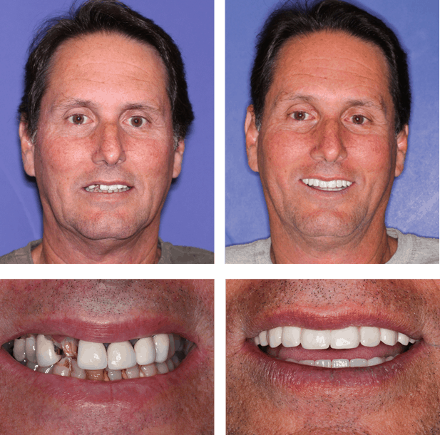 Tony - Teeth Next Day in Palm Beach Gardens, FL