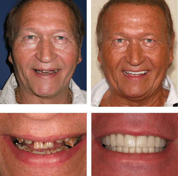 Ben - Teeth Next Day in Palm Beach Gardens, FL