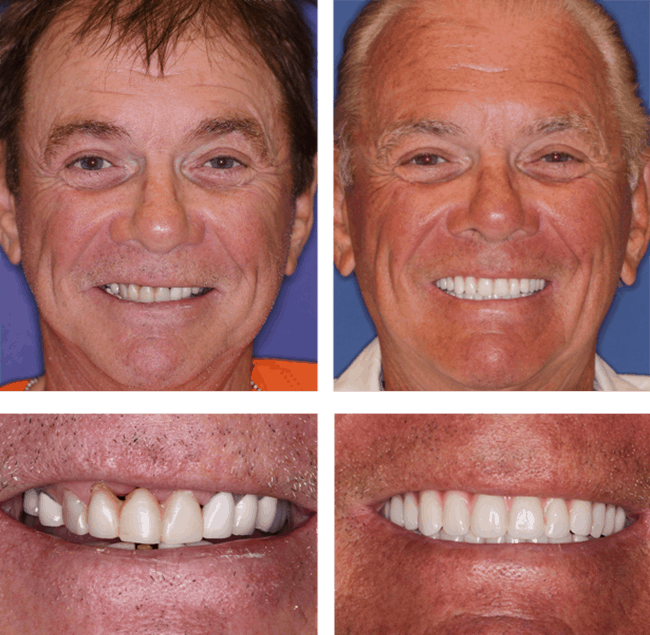 Teeth Next Day in Palm Beach Gardens, FL