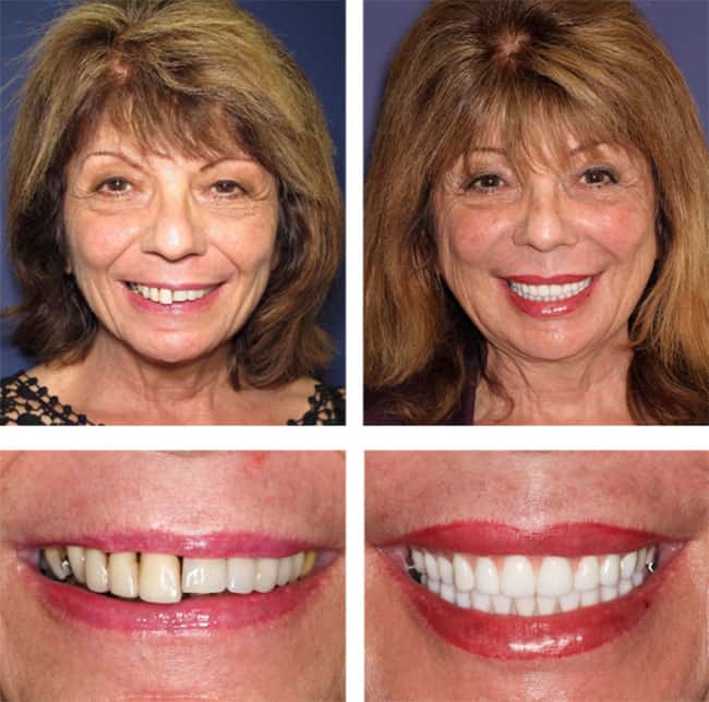 Teeth Next Day in Palm Beach Gardens, FL