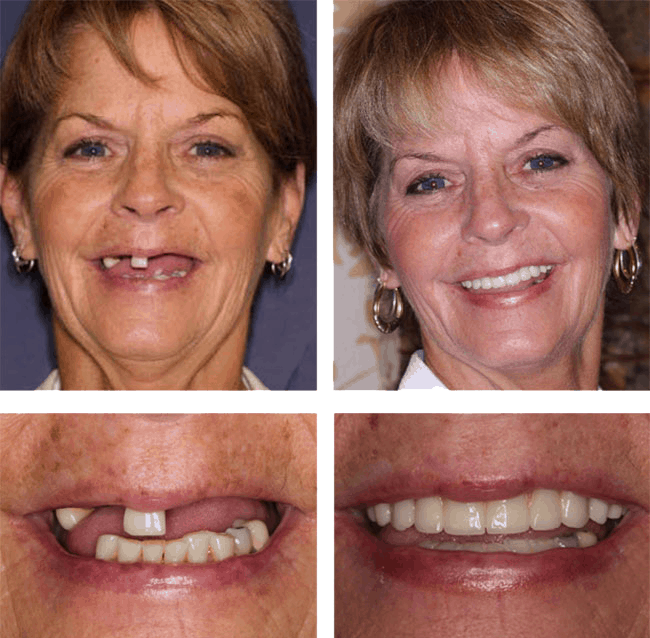 Teeth Next Day in Palm Beach Gardens, FL