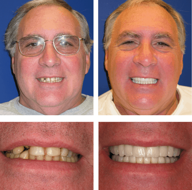 George - Teeth Next Day in Palm Beach Gardens, FL