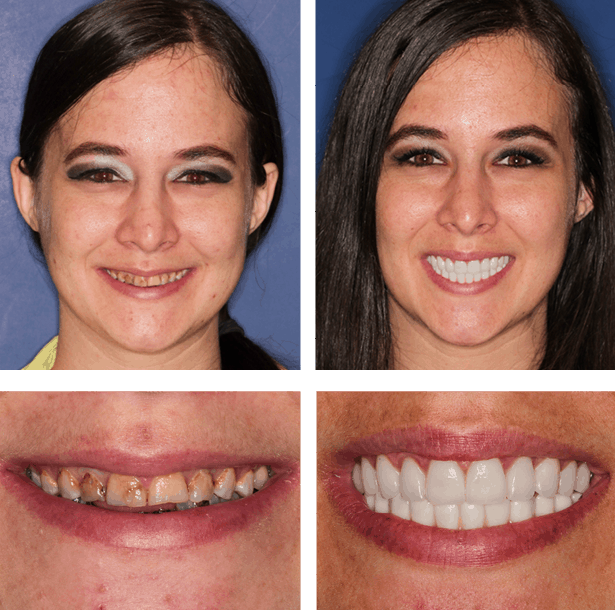 Teeth Next Day in Palm Beach Gardens, FL