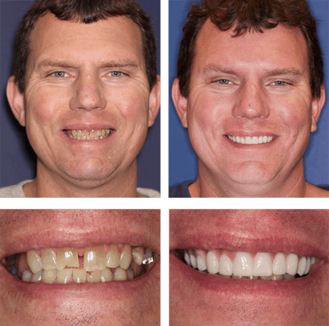 Teeth Next Day in Palm Beach Gardens, FL