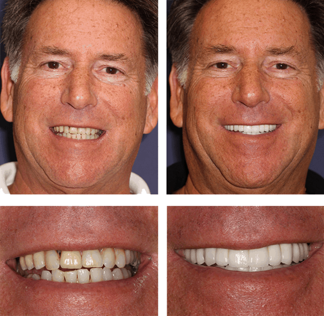 Teeth Next Day in Palm Beach Gardens, FL