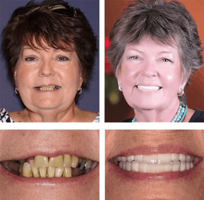 Teeth Next Day in Palm Beach Gardens, FL