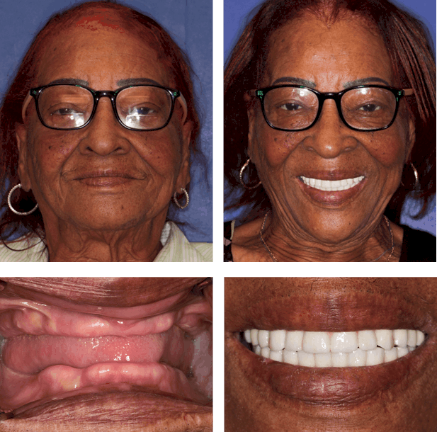 Mary - Teeth Next Day in Palm Beach Gardens, FL
