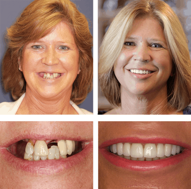 Teeth Next Day in Palm Beach Gardens, FL