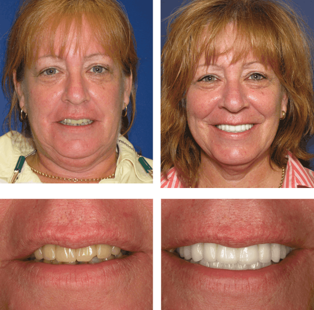 Sharon - Teeth Next Day in Palm Beach Gardens, FL