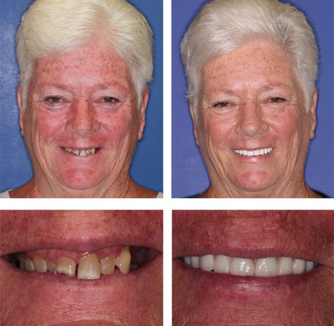Teeth Next Day in Palm Beach Gardens, FL