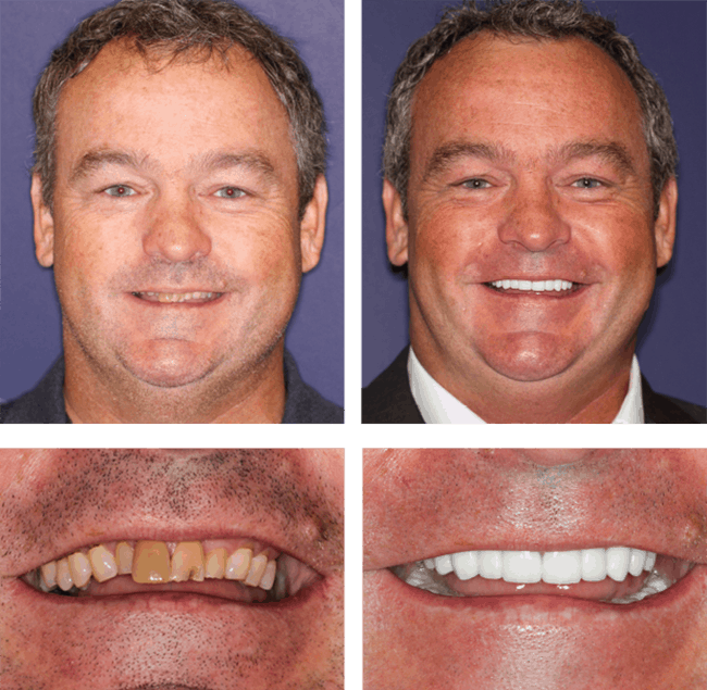 Teeth Next Day in Palm Beach Gardens, FL
